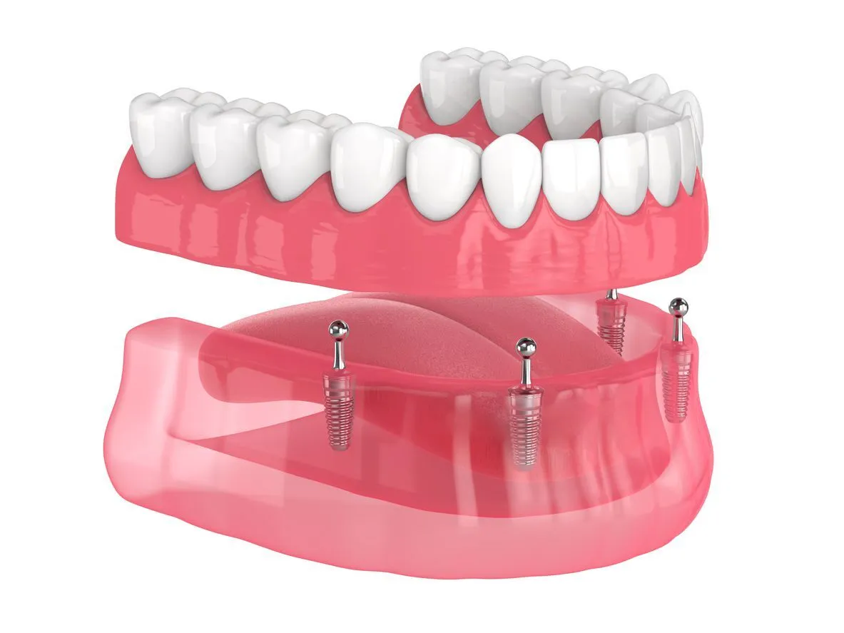 Implant Supported Dentures - Peterborough