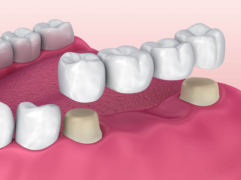 Dental Bridges - Peterborough