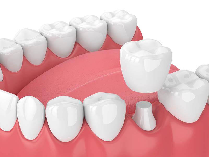 Dental Crowns - Peterborough