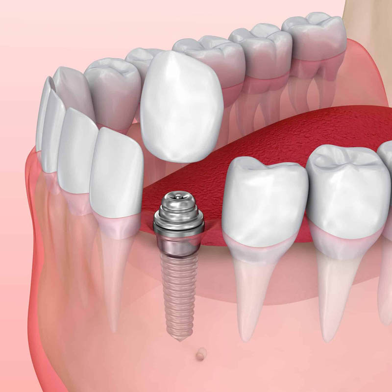 Dental Implants - Peterborough