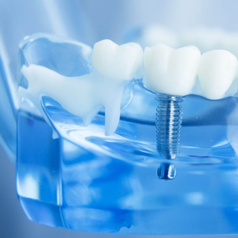 Dental Implants and replacement teeth - Peterborough