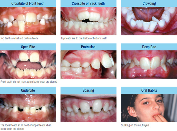 Dental problems to watch for in growing children